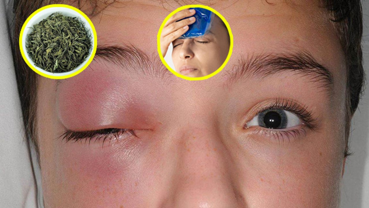 आई फ्लू में दर्द और खुजली होने पर क्या करें Eye Flu Mein Khujli Hone