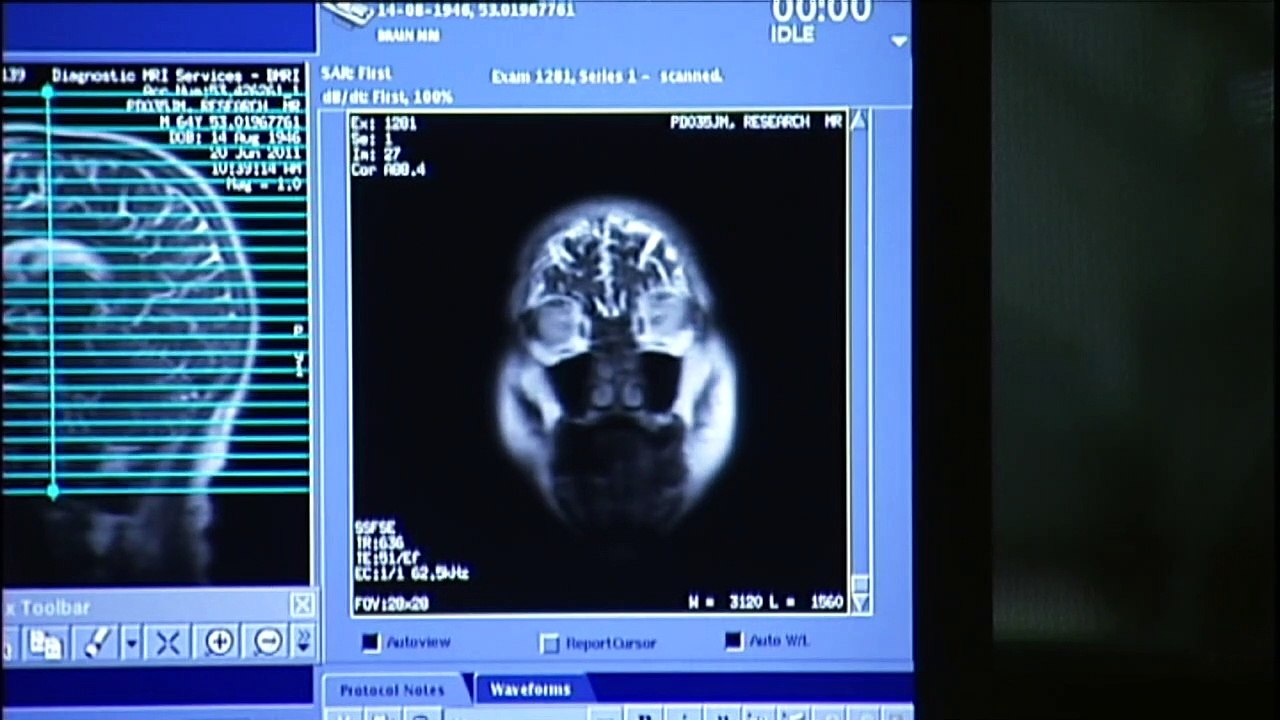 Scientists map brain changes caused by mental illnesses