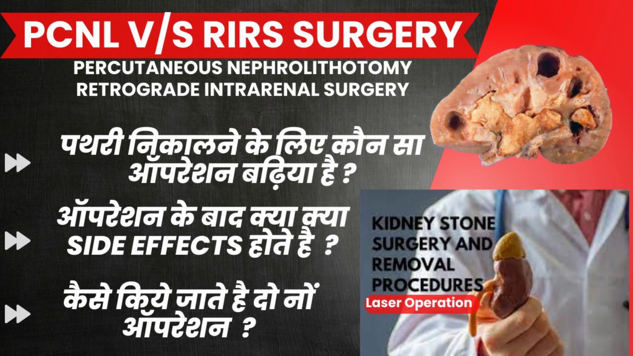 PCLS | RIRS | पथरी को निकालने के दो सफल ऑपरेशन | जानिये कौन सी SURGERY करवाएं | KIDNEY STONE SURGERY
