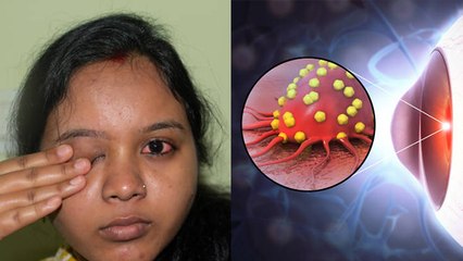 आई फ्लू में आंखे लाल होने पर क्या करें | Eye Flu Mein Ankhe laal Hone Par Kya Karein | Boldsky