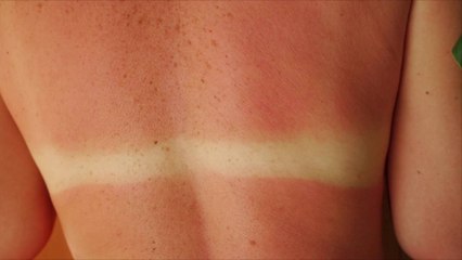 Research Suggests Sunbathing Could Impact Your Microbiome