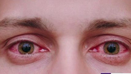 धार: आई फ्लू वायरस के बढ़ रहे मरीज,बचाव को लेकर करें यह उपाय