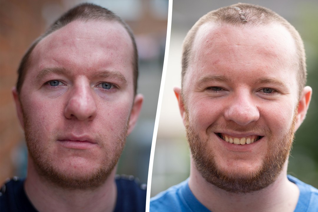 Man's skull rebuilt with plastic after brutal assault