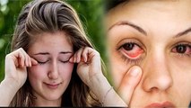 आंखो में खुजली होना आई फ्लू का पहला लक्षण है क्या | Ankho Me Khujli Hona Eye Flu First Symptom Hai