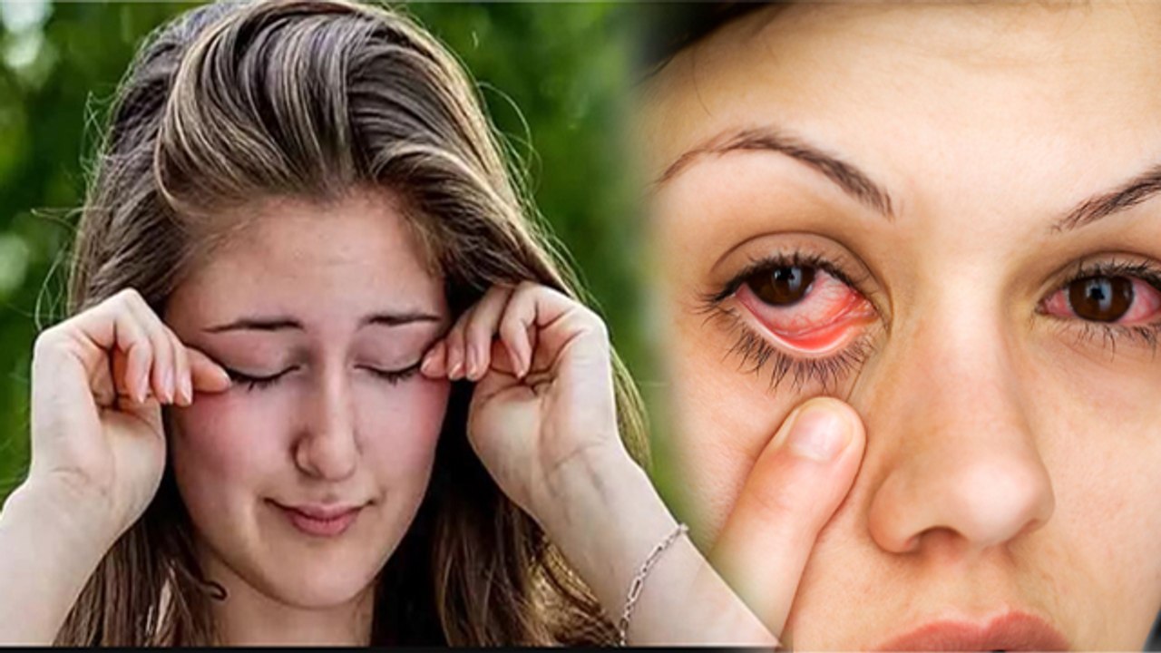 आंखो में खुजली होना आई फ्लू का पहला लक्षण है क्या Ankho Me Khujli