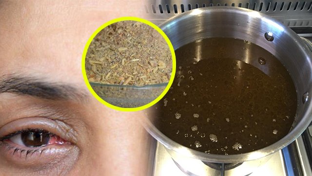 आई फ्लू से 1 दिन इस घरेलू उपाय से छुटकारा | Eye Flu Hone Par Kya Kare | Eye Flu Home Treatment