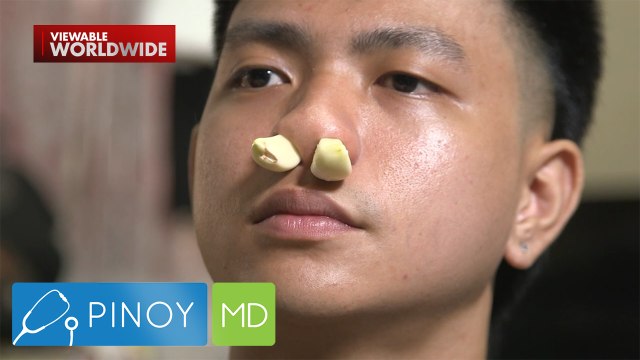Paglalagay ng bawang sa loob ng ilong, solusyon ba sa allergic rhinitis? | Pinoy MD