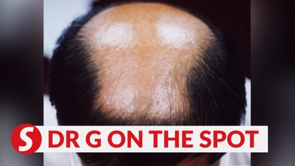 EP184: Testosterone and androgenic alopecia | PUTTING DR G ON THE SPOT