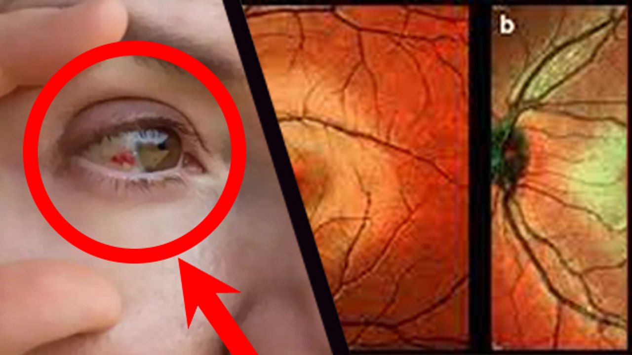 Eye Flu Repeat Hota Hai Kya Eye Flu Repeat Kyu Ho Raha Hai Eye Flu