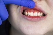Ortodontista Felipe Vieira dá dicas de como prevenir ou tratar casos de gengivite