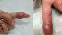Felon Finger Infection क्या है | Redness से लेकर Pain तक, Felon Finger Infection Symptoms | Boldsky