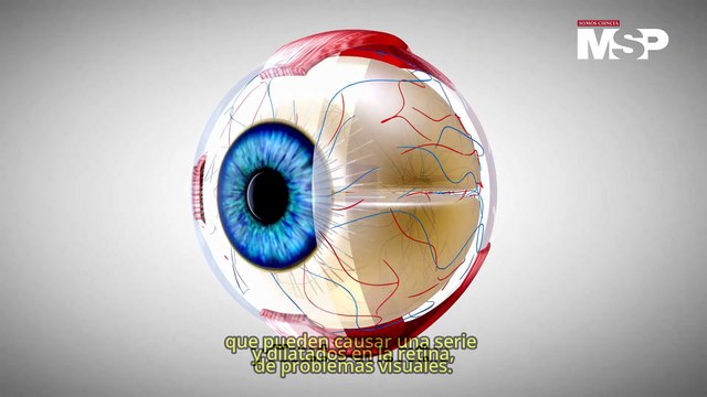 Enfermedad de Coats: ¿Qué es y cómo funciona esta afección ocular?