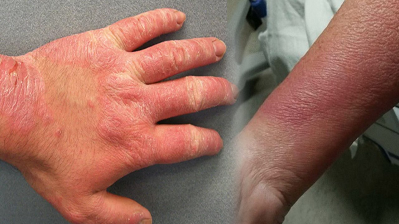 Chronic Inflaminmation Kya Hota Hai Arthritis से लेकर High Blood