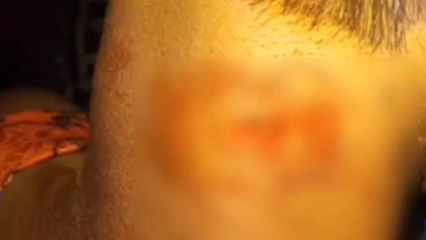 అన్నమయ్య జిల్లా: బాలికపై కుక్కల దాడి