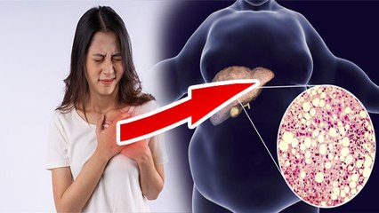 Fatty Liver से Heart Attack Risk कैसे, Expert Advice | Boldsky