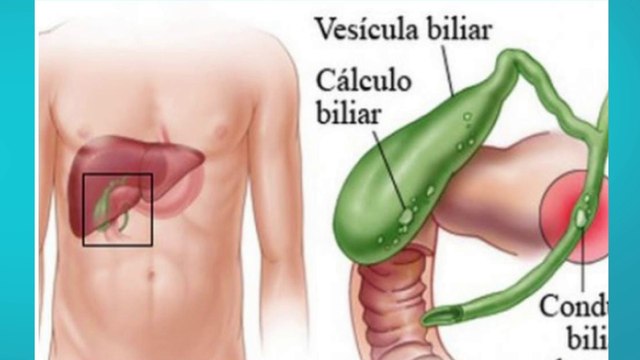 bd-piedras-en-la-vesicula-220823
