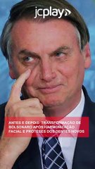 ANTES E DEPOIS: TRANSFORMAÇÃO DE BOLSONARO APÓS HARMONIZAÇÃO FACIAL E PRÓTESES DOS DENTES NOVOS