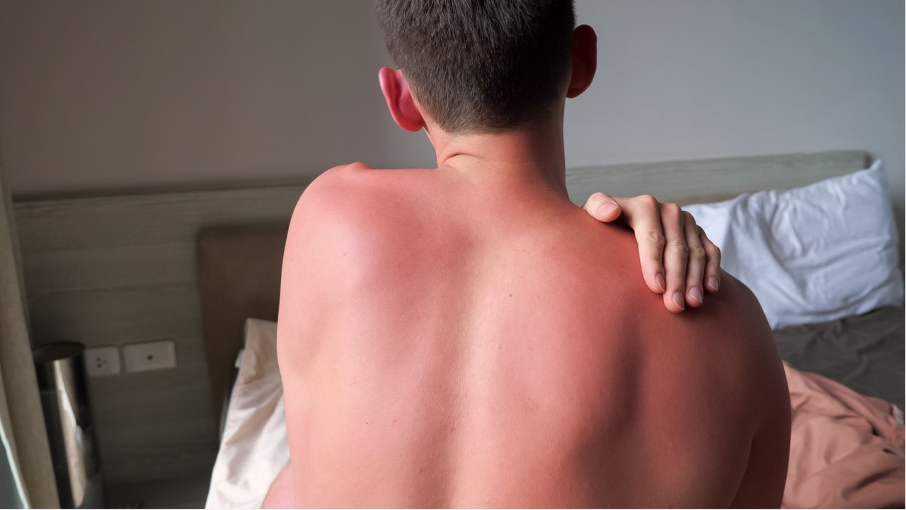 Dermatologin verrät: So können Sie trotz Sonnenbrand gut schlafen
