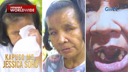 44-anyos na kasambahay, nabulag at nabungi matapos pagmalupitan diumano ng amo | Kapuso Mo, Jessica Soho