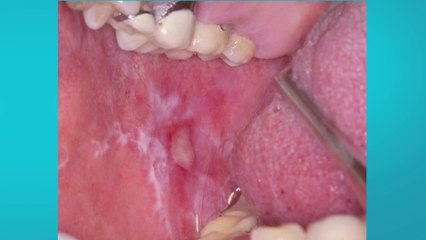 bd-deteccion-temprana-de-cancer-230823