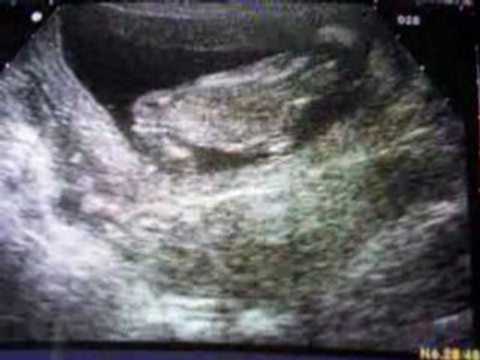 ecchographie 3ime mois