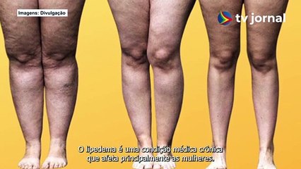 Скачать видео: LIPEDEMA: O QUE É, QUAIS OS SINTOMAS, CAUSAS E TRATAMENTO da doença?