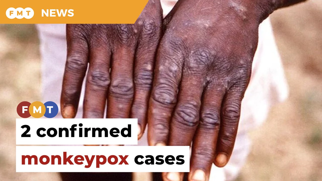 2 monkeypox cases reported in Malaysia