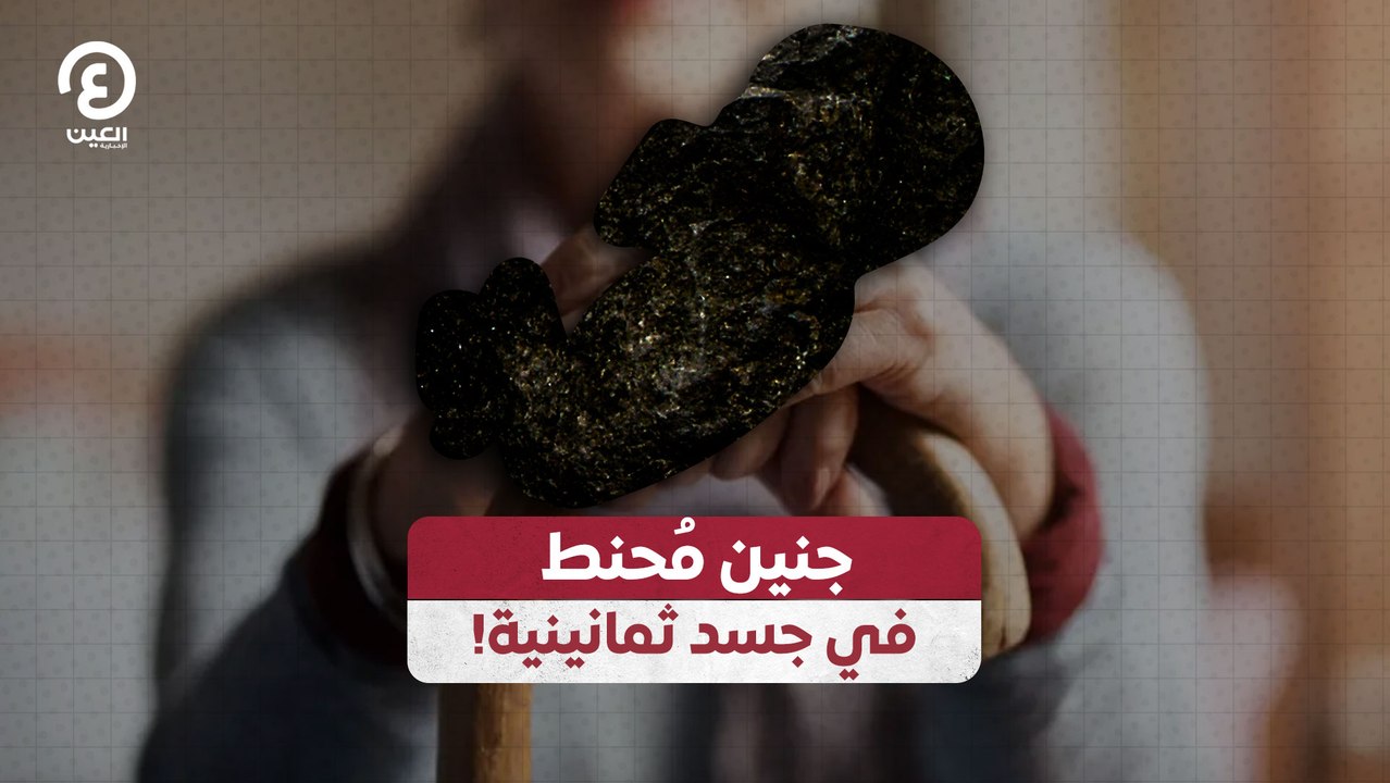 !جنين مُحنط في جسد ثمانينية