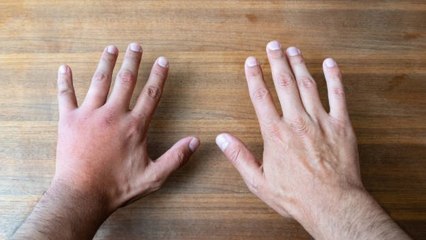 El Motivo Por El Que Se Te Hinchan Las Manos Al Correr