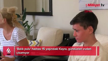 'Balık pulu' hastası 15 yaşındaki Kayra, gündüzleri evden çıkamıyor