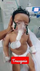 Small baby How to get Relief of breathing difficulty by Nebulizer.
