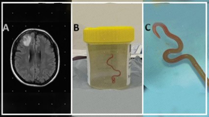 Schockierende Operation: Lebender Wurm aus dem Gehirn einer Frau entfernt 🧠