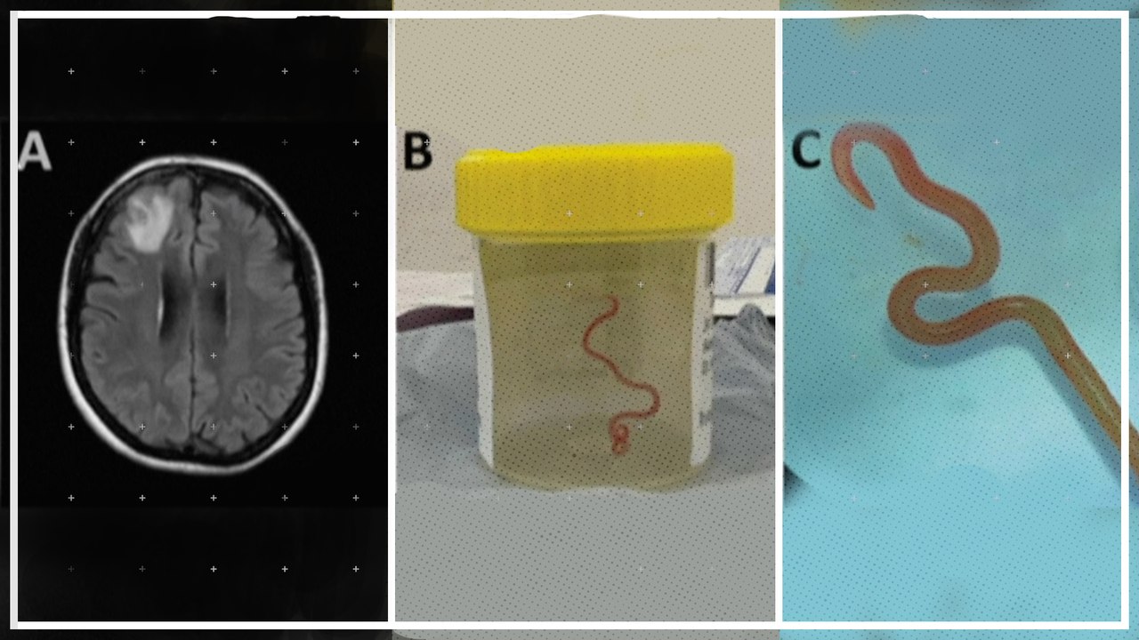 Lebender Wurm aus Gehirn von Frau herausoperiert