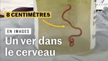 Australie : un ver vivant retiré du cerveau d’une patiente