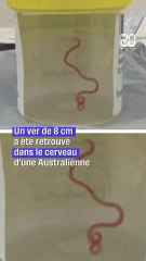 Un ver de 8 centimètres découvert dans le cerveau d’une Australienne #shorts