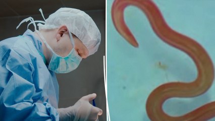 Un ver de 8 cm découvert « vivant et se tortillant » dans le cerveau d’une Australienne