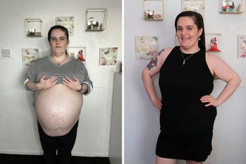 Nottingham woman feels like “a new person” after 16 litres of fluid was drained from her stomach.