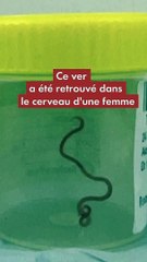 Un ver a été retrouvé dans le cerveau d'un femme en Australie