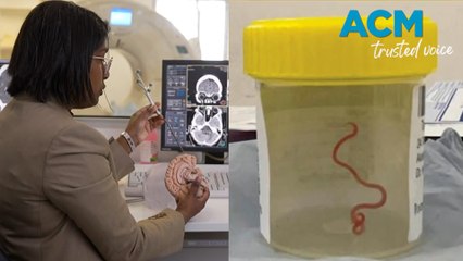 Rare Case: Live Parasitic Worm Discovered in Australian Woman’s Brain 🧠