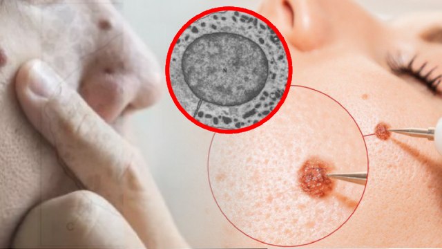 Chehre Par Masse Hone Ka Karan | Chehre Par Til Kyu Nikalte Hain | चेहरे पर तिल मस्से होने का कारण