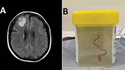 Surgeon Finds Live 3-Inch Worm in Woman’s Brain After She Becomes ‘Accidental Host’