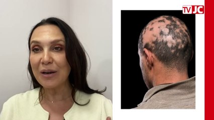O QUE É ALOPECIA? Saiba mais detalhes da doença de VIRGÍNIA FONSECA