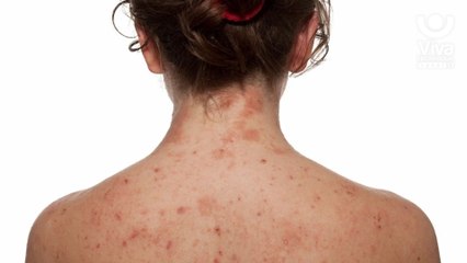 Causas, síntomas y tratamientos de la Dermatitis Atópica