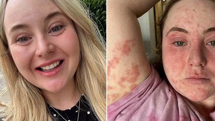 ‘A trip to the dentist left me with painful elephant skin all over my face and body’