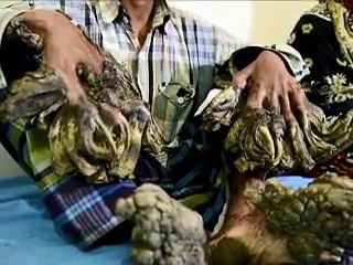 Bangladesh: un "homme-arbre" aux excroissances impressionnantes opéré