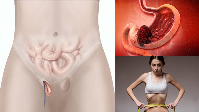 Jelly Belly Cancer Kya Hai | Jelly Belly Cancer Symptoms In Hindi | Jelly Belly Cancer Treatment