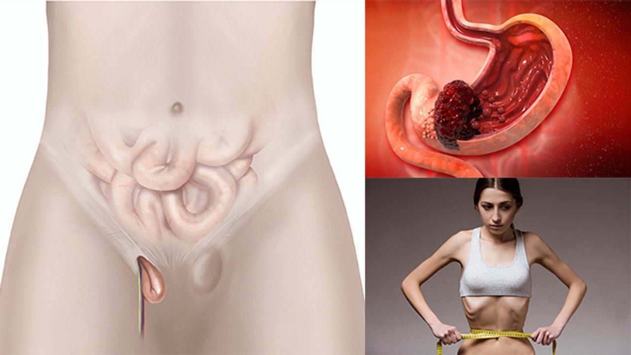 Jelly Belly Cancer Kya Hai | Jelly Belly Cancer Symptoms In Hindi | Jelly Belly Cancer Treatment