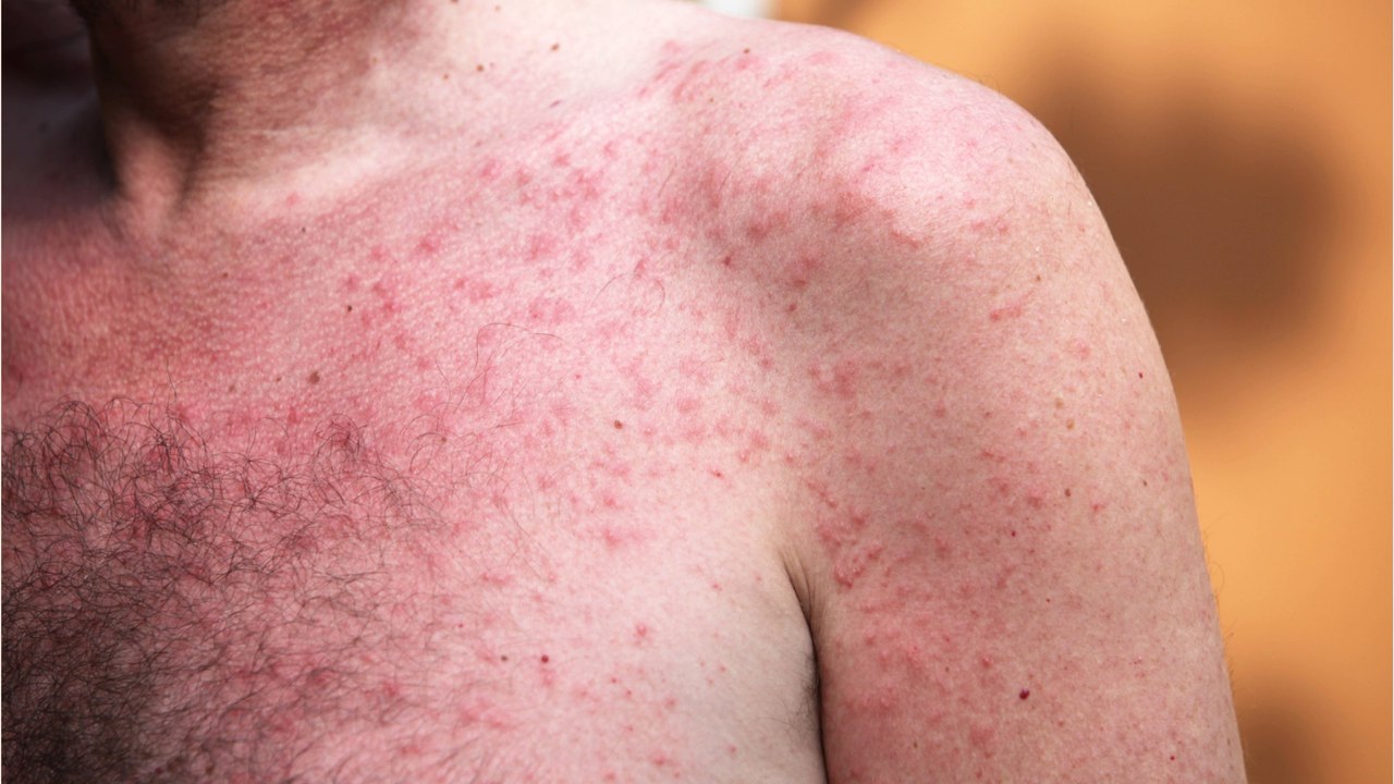 Nach dem Sonnenbad: Was hilft bei Mallorca-Akne?