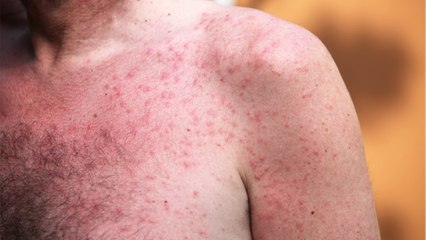 Nach dem Sonnenbad: Was hilft bei Mallorca-Akne?