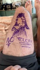 "Mejor prevenir que lamentar": Paciente pinta su pierna sana, para que operen la rodilla correcta